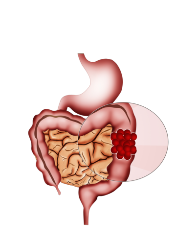 colon cancer